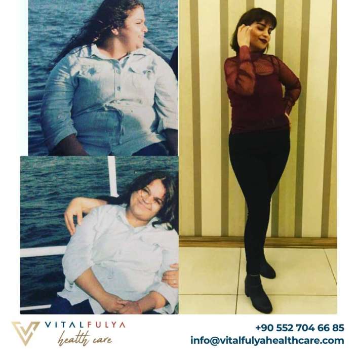 Gastric Sleeve Before & After in Istanbul