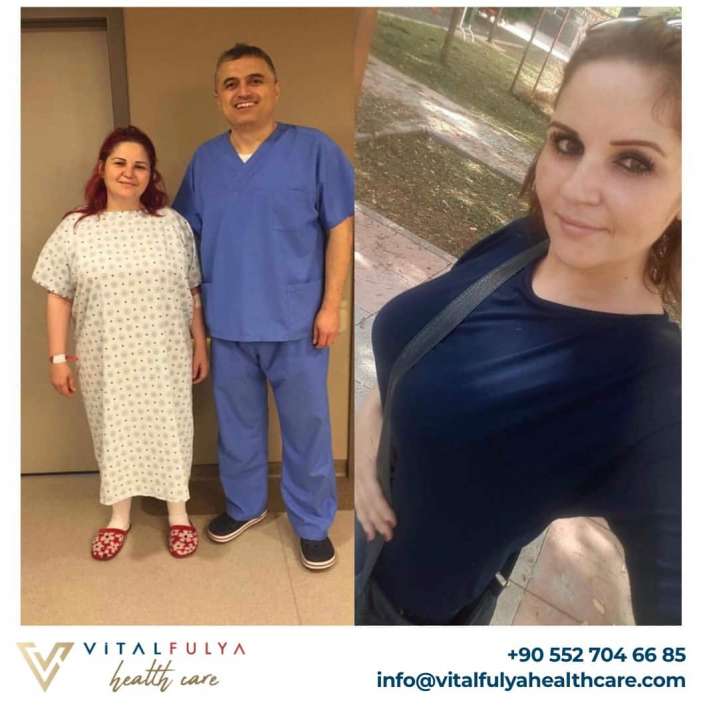Gastric Sleeve Before & After in Istanbul